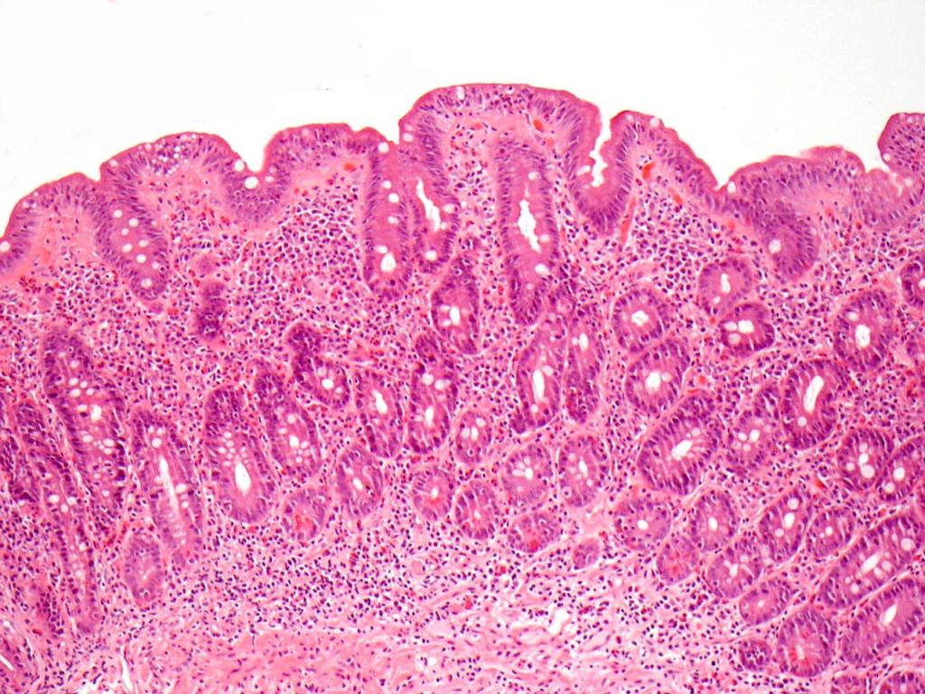 What is Celiac&nbsp;Disease?